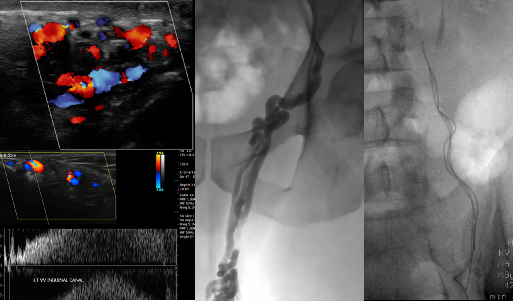 GEST 2018 Abstract Novel “Uncoil Coil” Technique for Varicocele